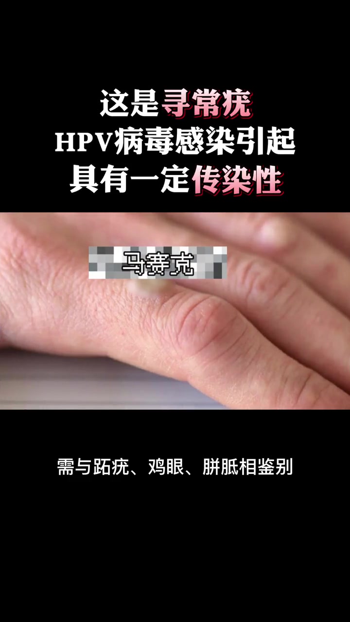 手上长了硬硬的小疙瘩,剪了还会有,可以这样处理 科普 瘊子 疣