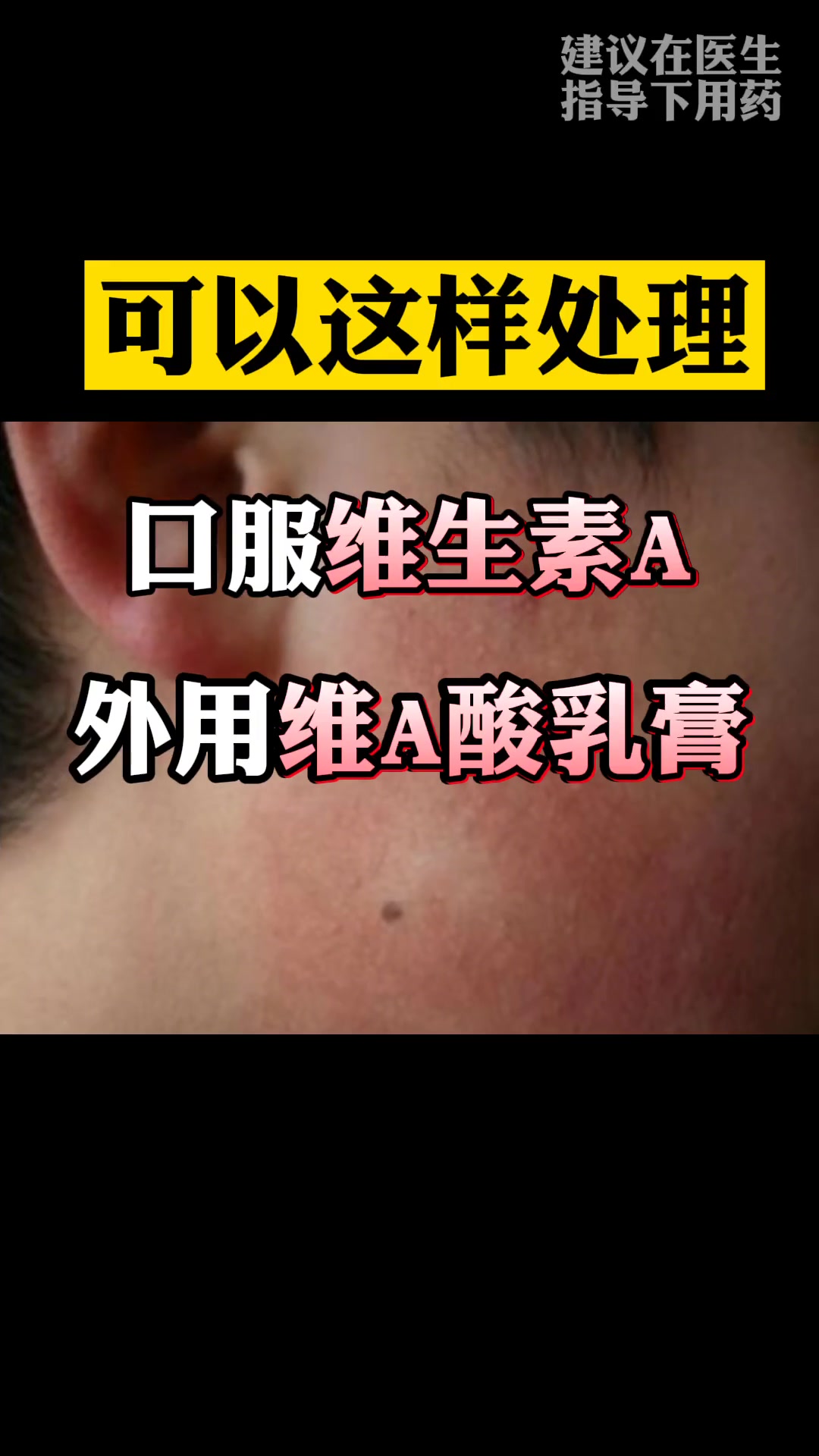 脸上长小疙瘩,摸起来很粗糙,不是“鸡皮肤”,可以这样处理 科普 鸡皮肤 皮肤