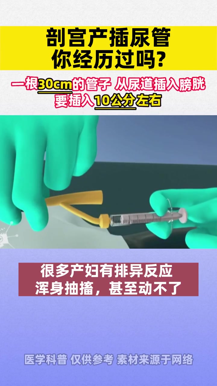 剖宫产三大关:插尿管拔尿管,第一次下地走,剖完以后压肚子,你最害怕哪个?医学科普 剖宫产 