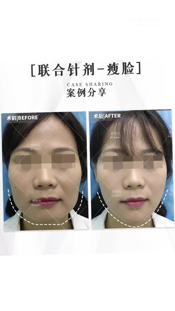 医美 瘦脸 瘦脸针  瘦脸针里面的主要成分是肉毒素,通过注射的方式将这种成分注入到咬肌内,
