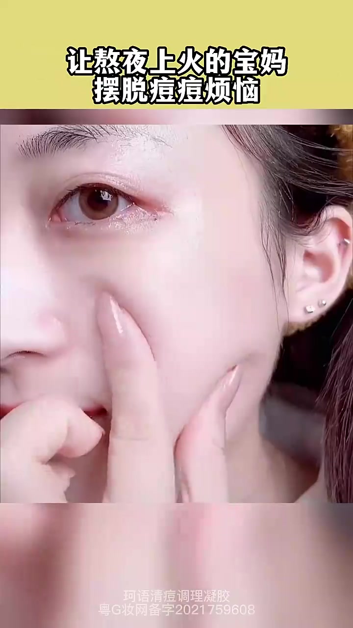 痘痘挤出白色了“脓液”?但是痘根还在,祛痘误区,你不能不知道