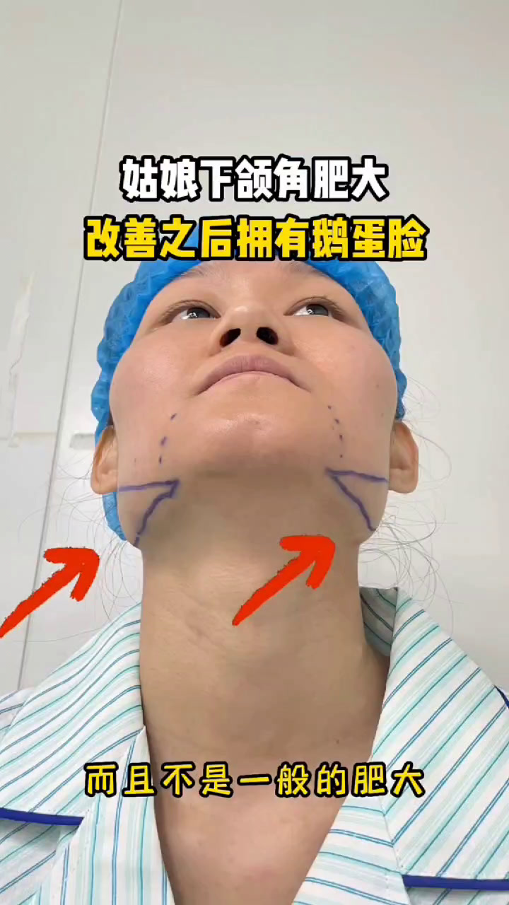 20岁小姑娘天生下颌角肥大,做完磨骨后改善成功,拥有精致鹅蛋脸