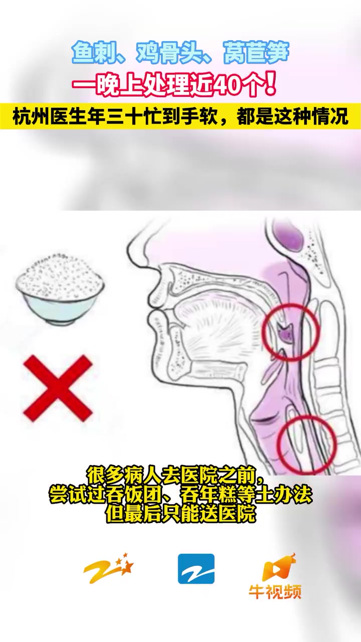 「除夕夜鱼刺卡喉病人增加」1月21日,杭州。浙江省人民医院耳鼻咽喉科主任助理、副主任医师胡