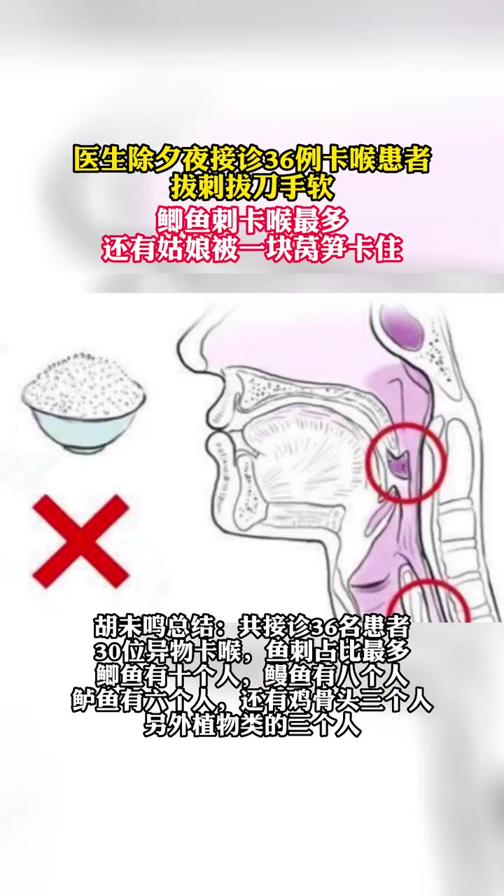 医生除夕夜接诊36例卡喉患者,拔刺拔到手软,鲫鱼刺卡喉最多还有姑娘被一块莴笋卡住