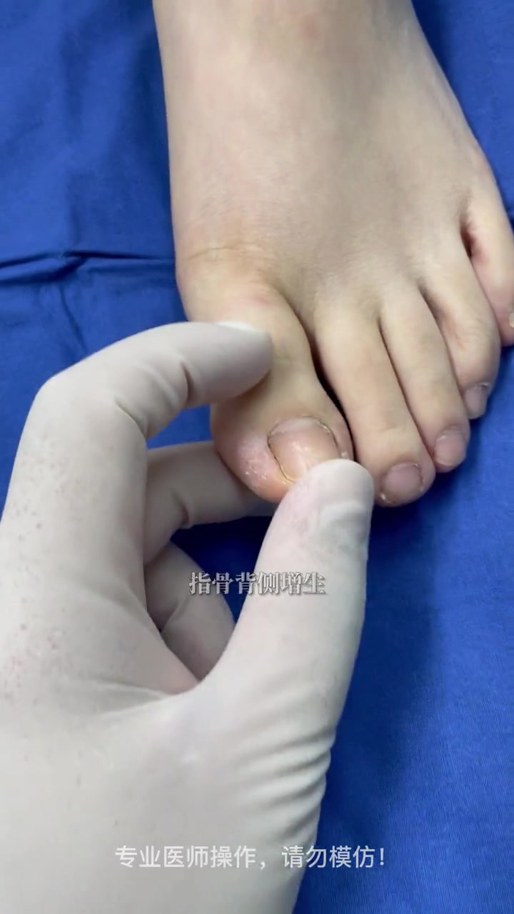 任性的指甲都是倒着长的!嵌甲 指甲修复 甲病 手术室你不知道的事
