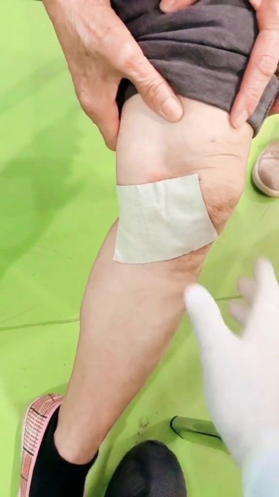鹅足肌腱炎一般多久自愈
