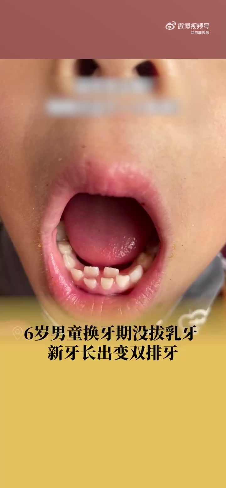 「6岁男童乳牙未掉长新牙变双排牙 医生:建议2岁后吃辅食别太精细「话筒」」近日,四川成都。