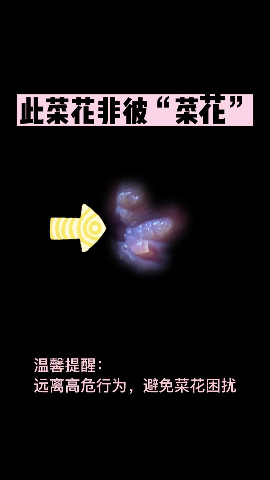 菜花状疣有什么症状,看图就懂!