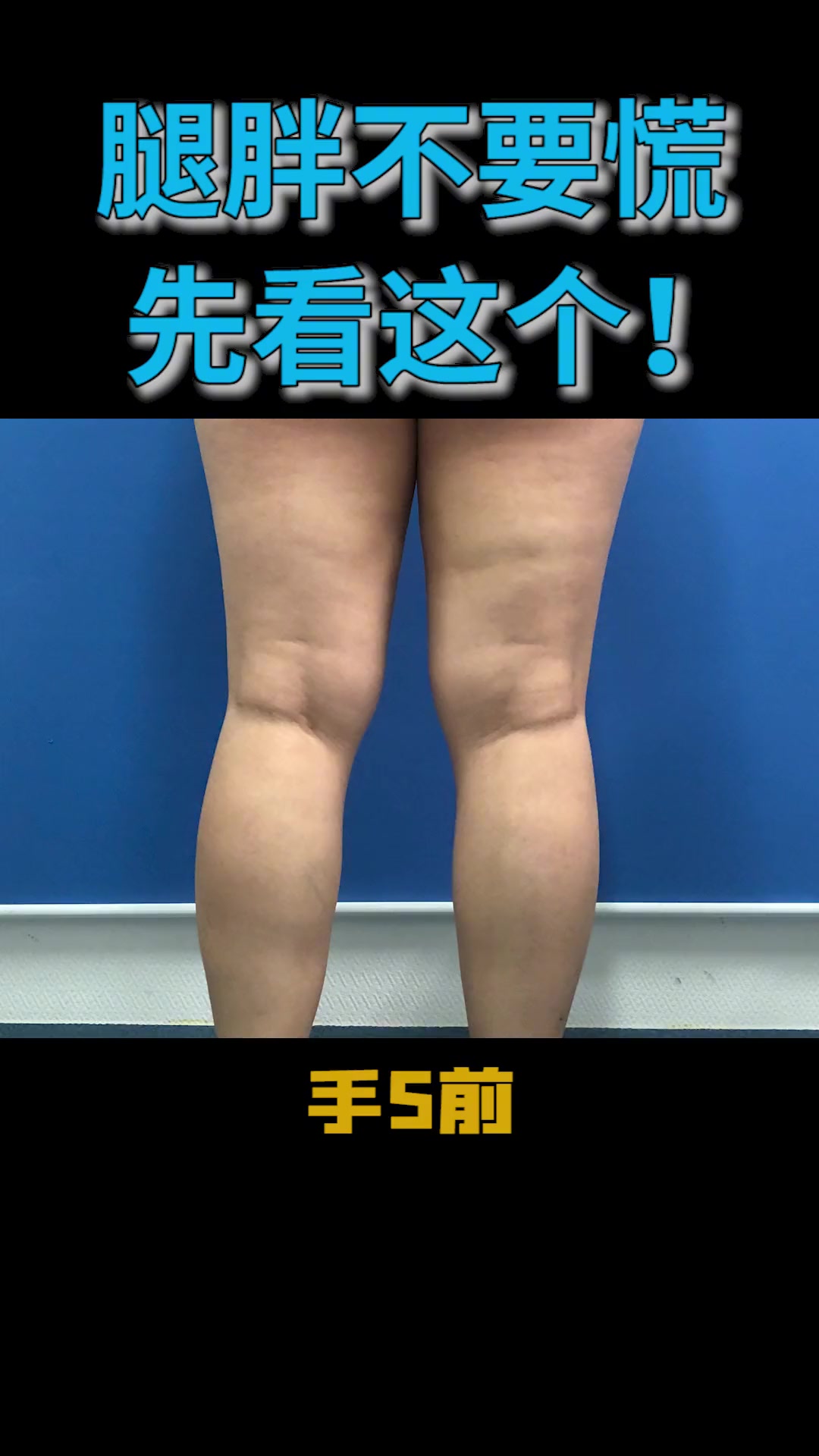 膝盖抽脂前后对比