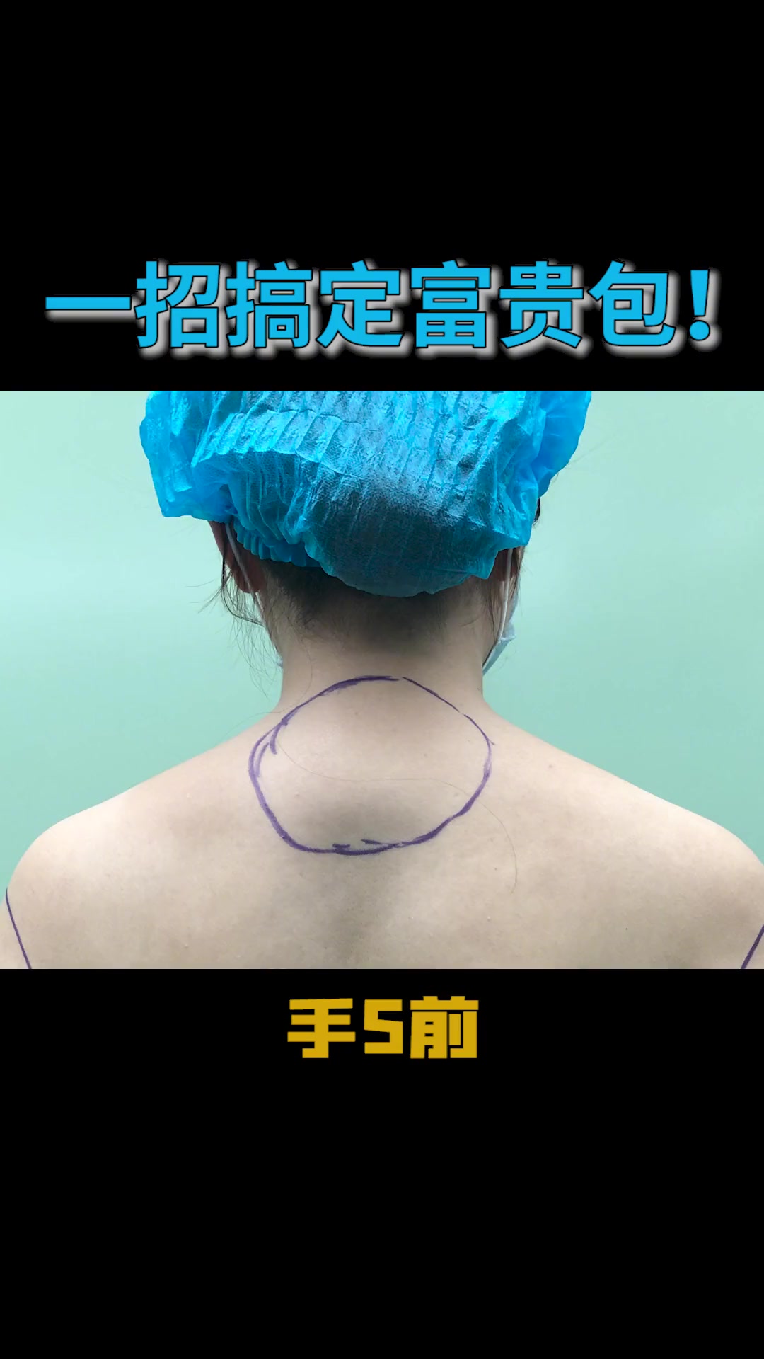 第12集|富贵包 抽脂 前后对比,这个效果怎么样呢?减肥