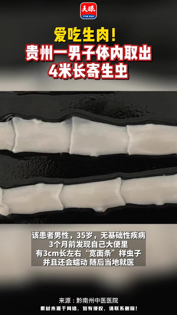 爱吃生肉!贵州一男子体内取出4米长寄生虫