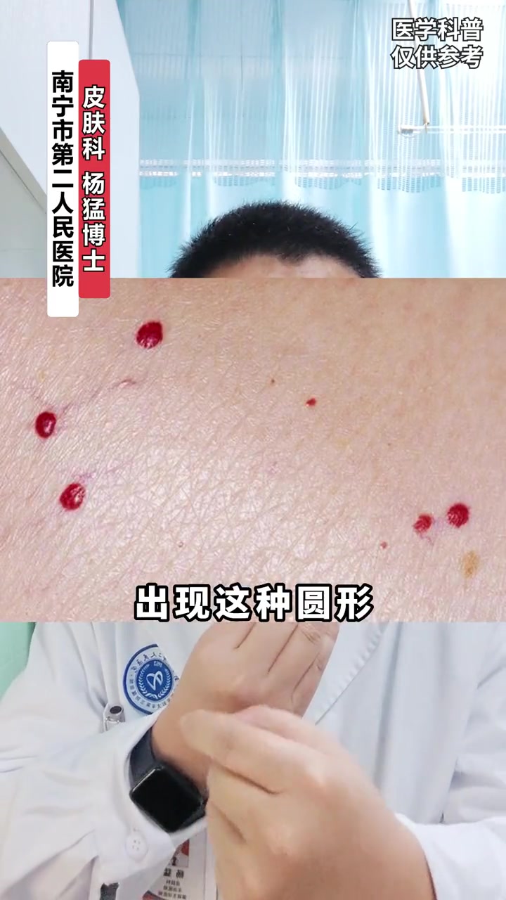 身上长了这种小红点,不要太过担心 樱桃状血管瘤 皮肤健康 医学科普
