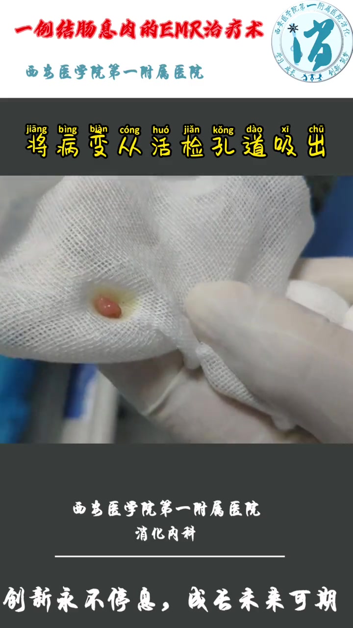 肠息肉怎么做手术
