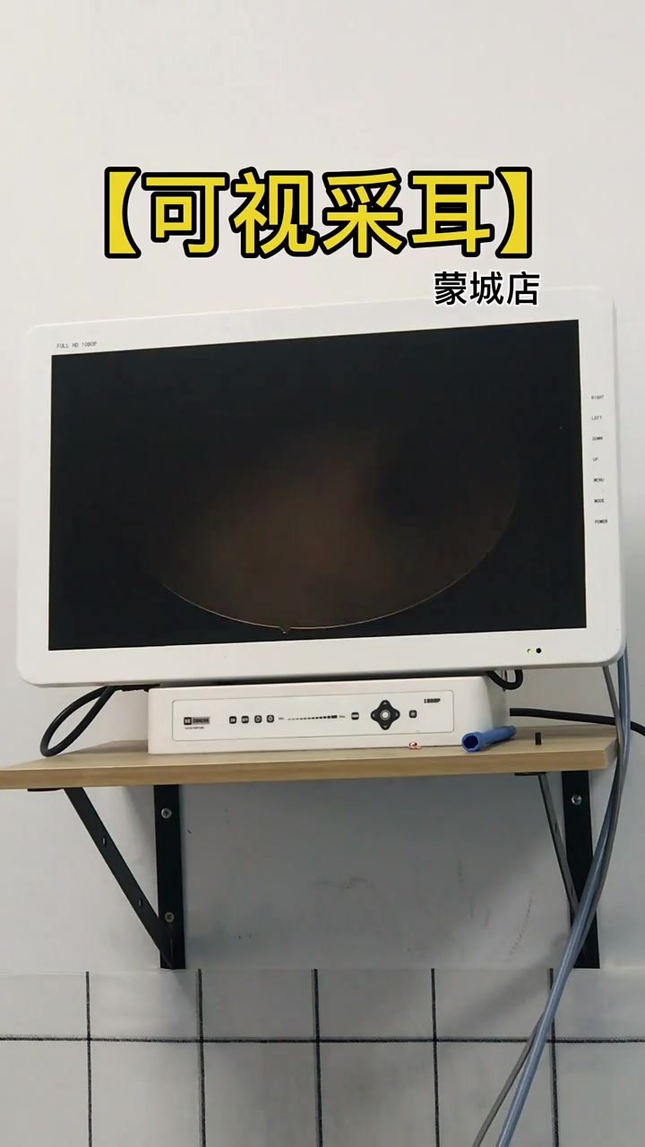 耵聍完全阻塞外耳道,可使听力减退,若遇水膨胀,可致听力骤降,耳闷及耳痛 甚至可以诱发外耳道