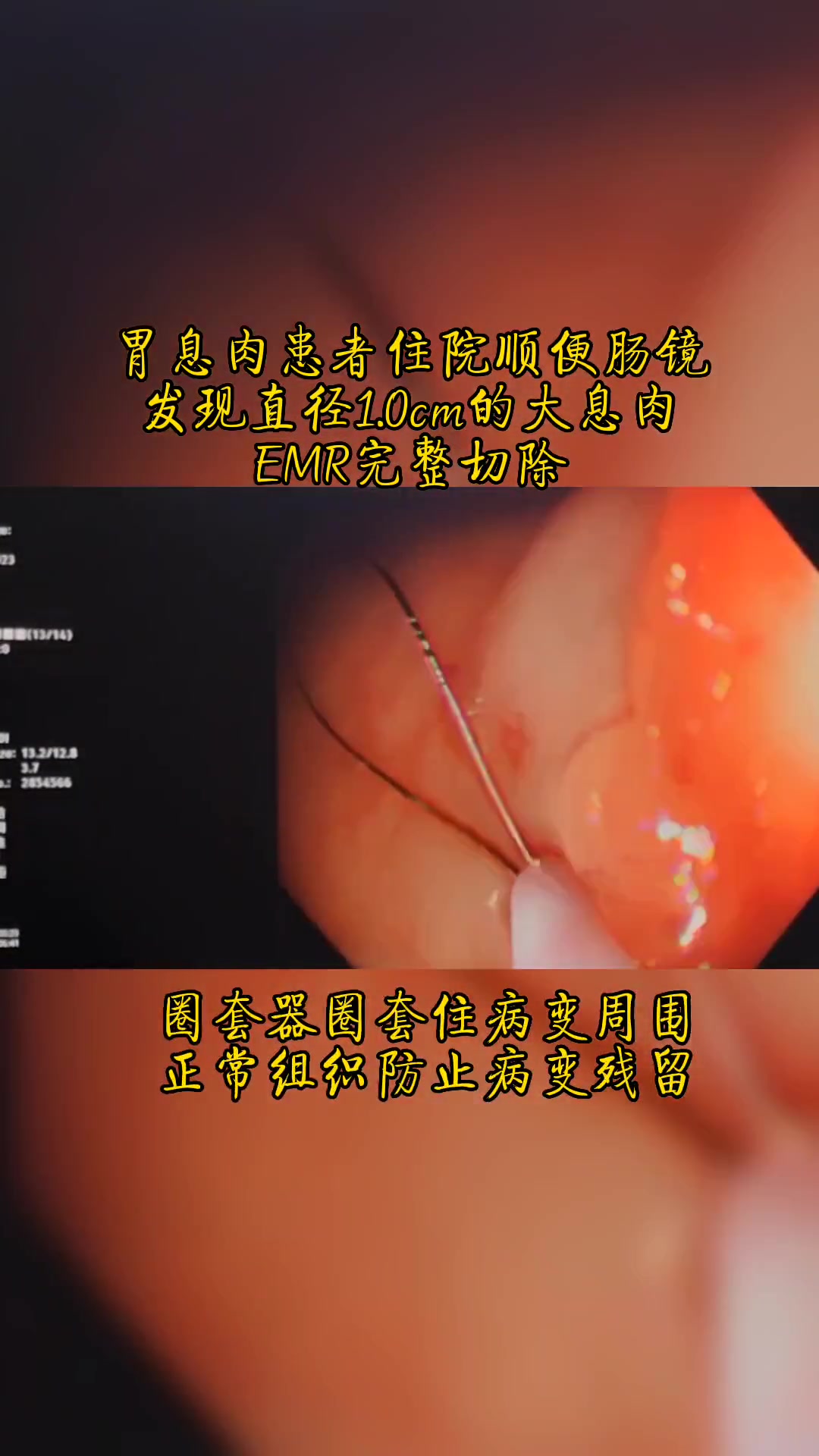 内镜视频:胃息肉患者住院顺便肠镜,发现直径1.0cm的大息肉,EMR完整切除。胃息肉也建议