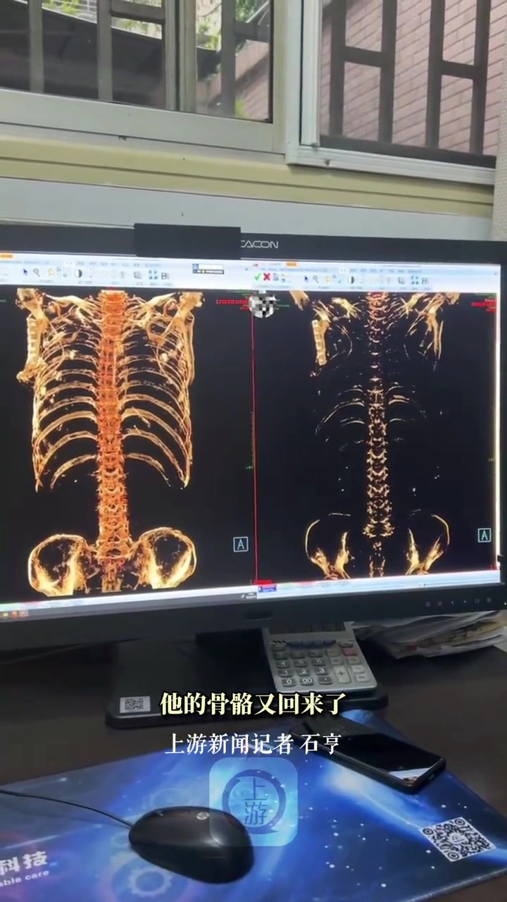 近日,重庆,男子严重缺钙CT下就像一个透明人(上游新闻记者 石亨)