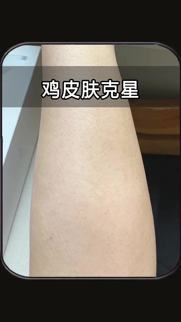 身上那些密密麻麻的小点,到底是什么?如何祛除?好物 鸡皮肤