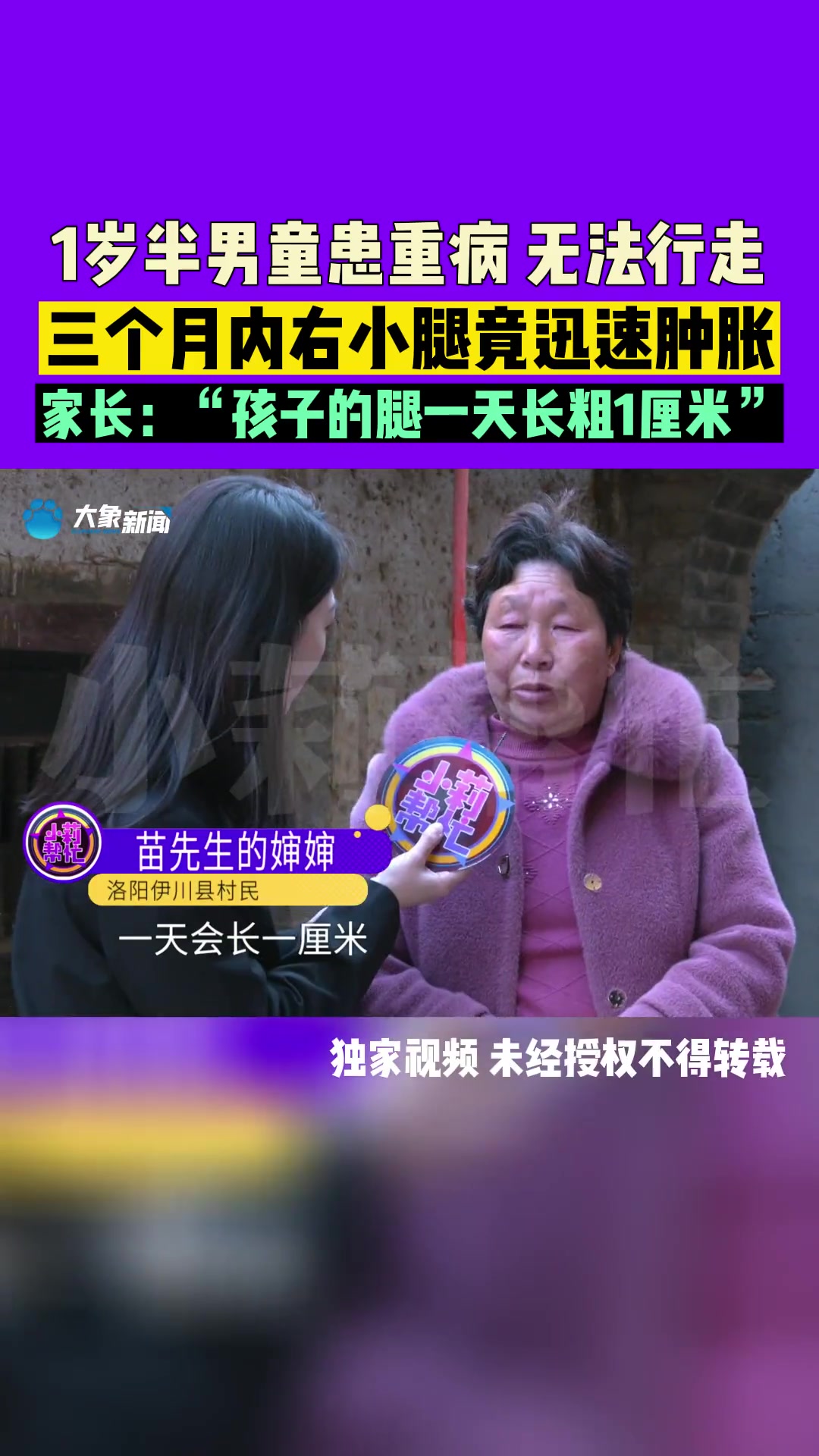 洛阳伊川:1岁半男童右小腿肿胀迅速,“一天长粗一厘米”