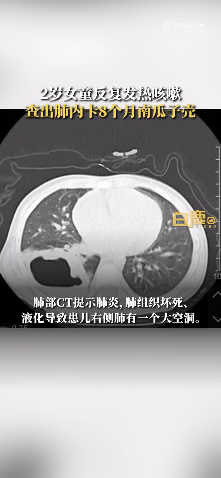 「2岁女童咳嗽查出瓜子壳卡肺8个月 肺组织坏死现空洞」近日,浙江杭州。2岁女童因连续三天发