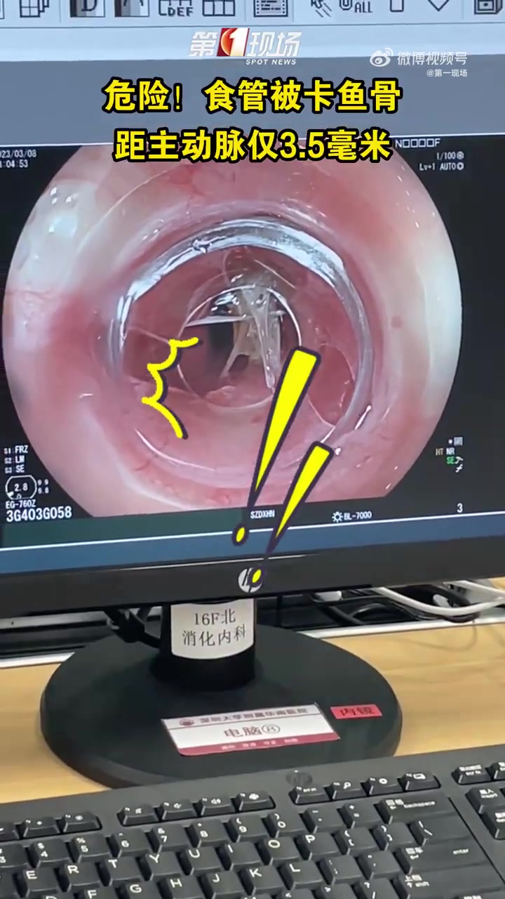「心惊!深圳女子吃零食被卡住险刺主动脉」上班之余,深圳的张女士拿着自带的小零食鱼尾解解馋。