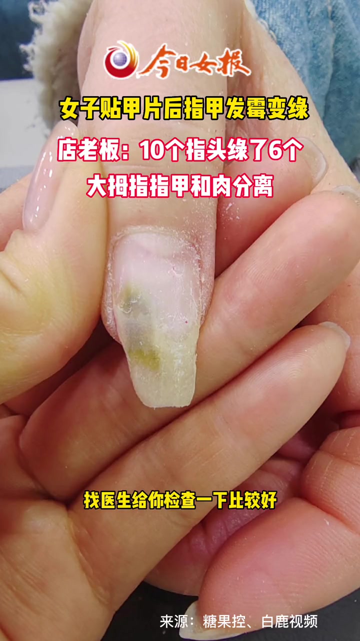 女子贴甲片后指甲发霉变绿,店老板:10个指头绿了6个,大拇指指甲和肉分离,劝她就医仍坚持做