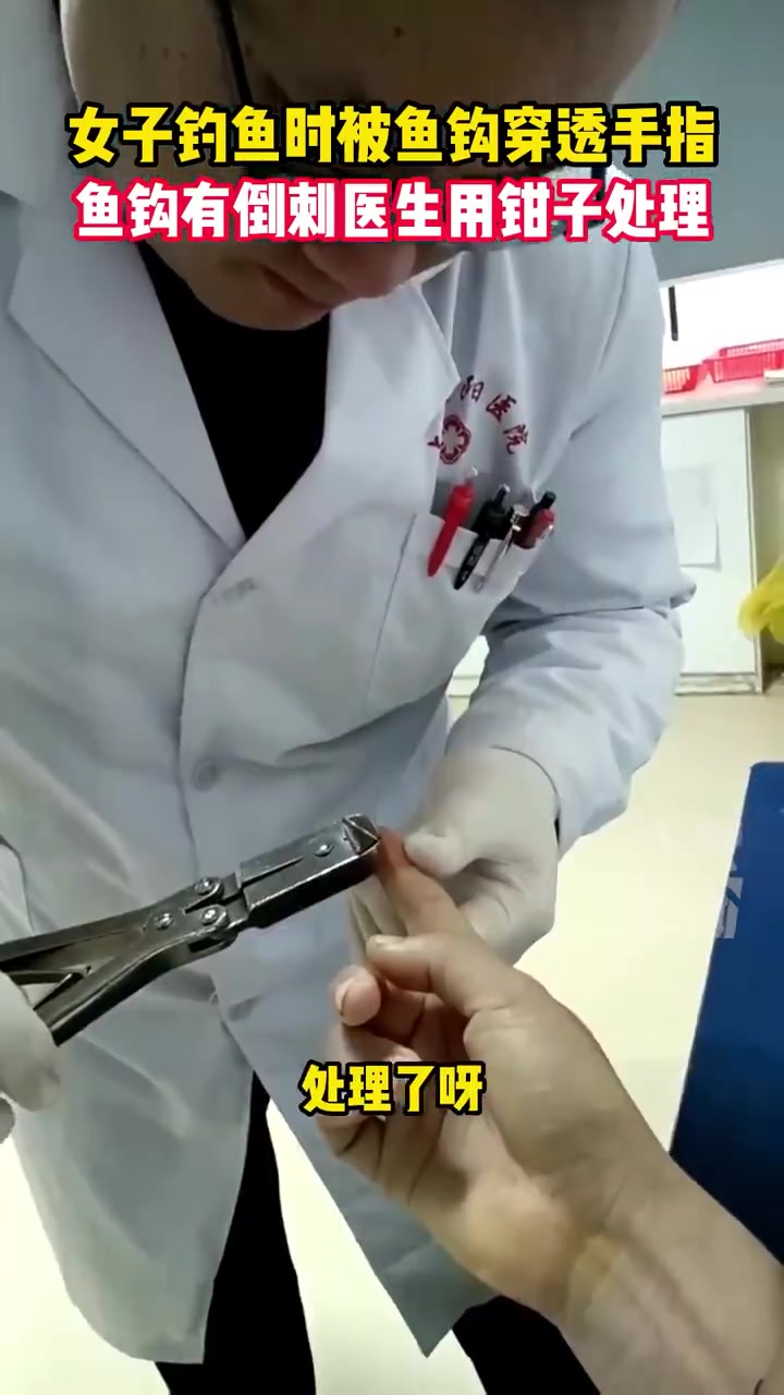 女子钓鱼提竿用力过猛鱼钩扎穿手指「女子钓鱼时被鱼钩穿透手指,鱼钩有倒刺医生用钳子处理」手指
