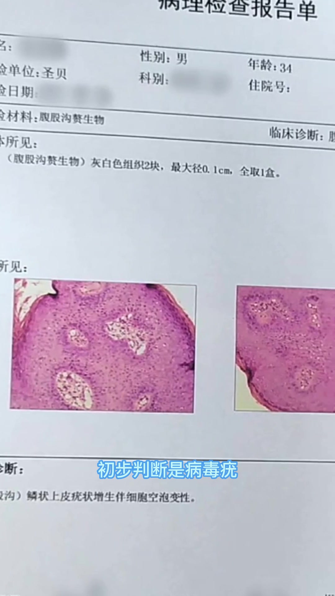 34岁男性腹股沟长菜花,这是检查报告