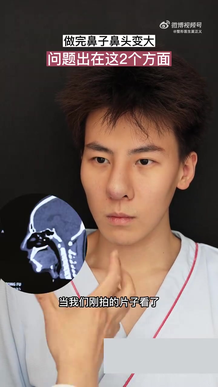 「安全问题永远是第一位的」小伙子,1年多以前在外院做的膨体耳软骨鼻综合手术,现鼻头变大,严