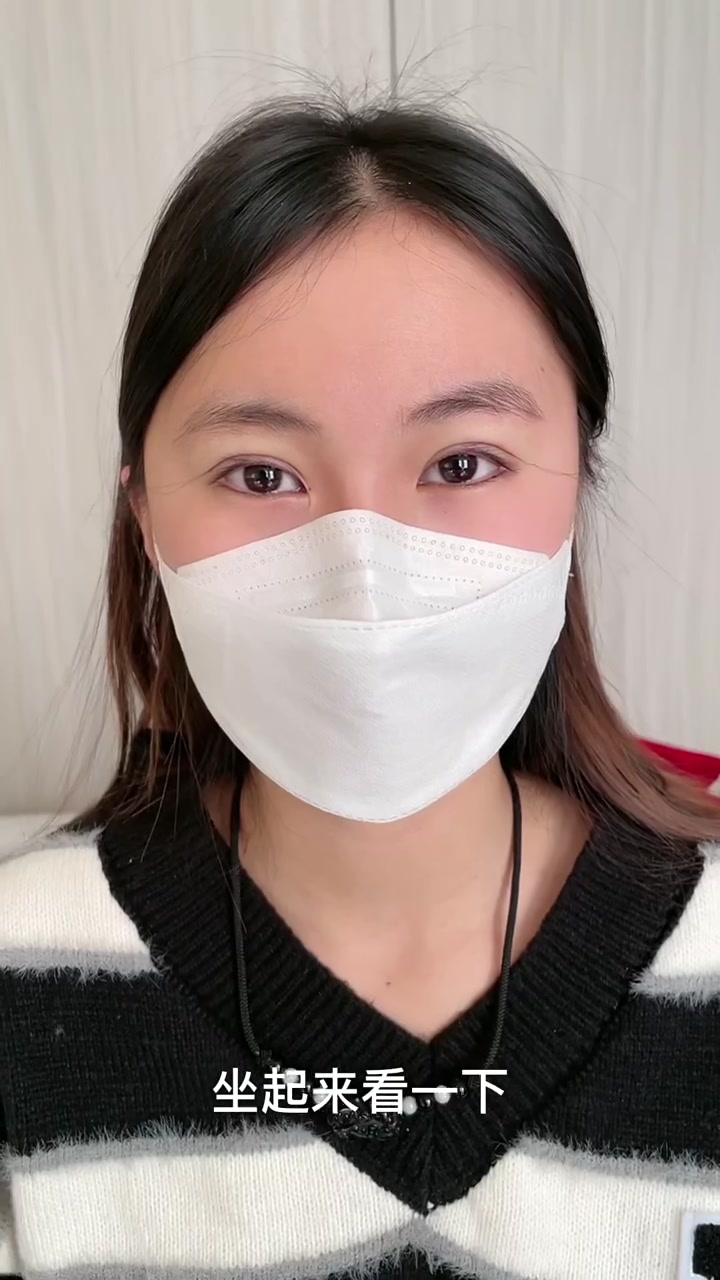 全切双眼皮成功解救了我的“死鱼眼”,闺蜜“吐槽”我换头成功!