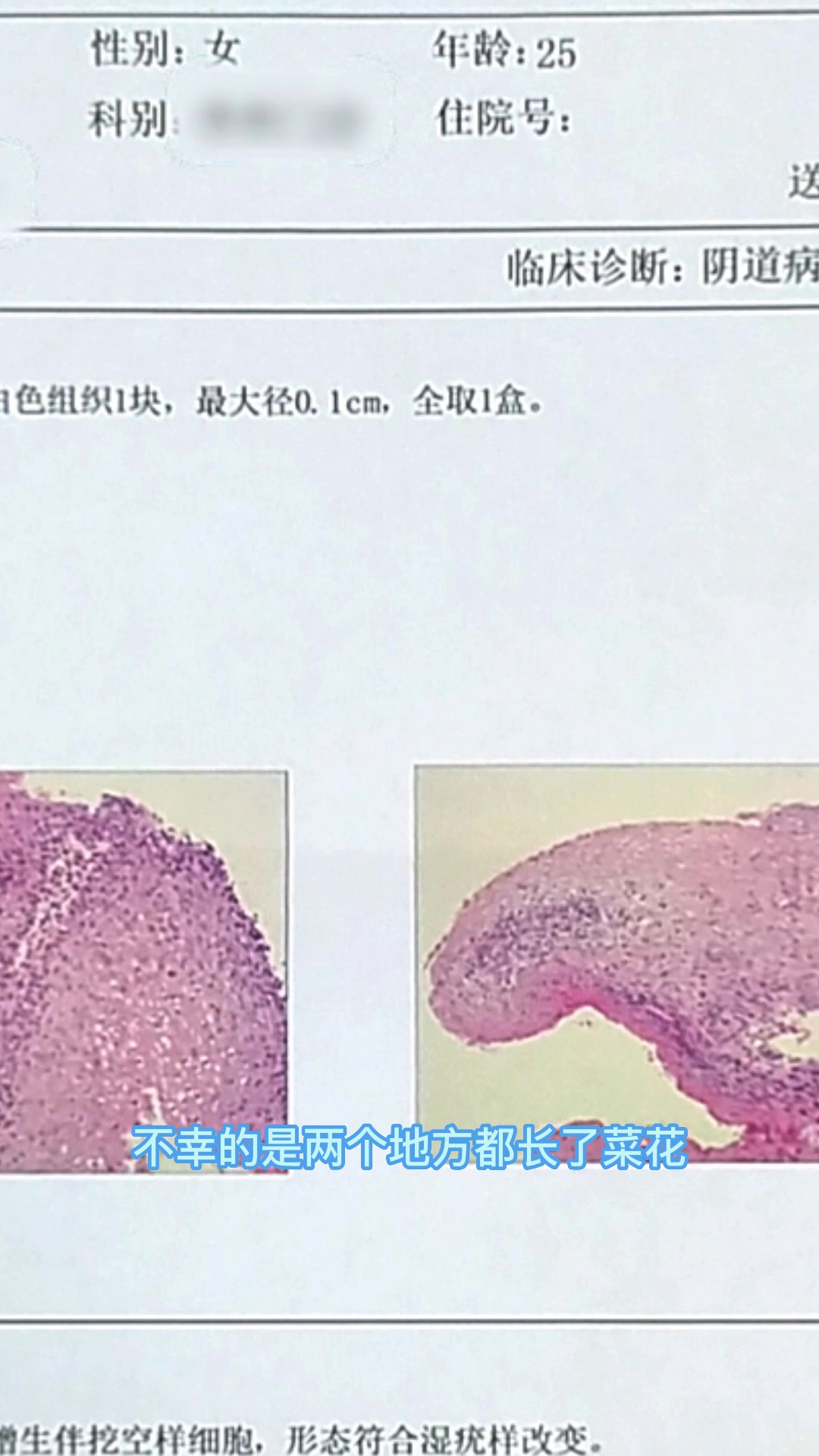 25岁女性三个地方长了菜花,十分棘手