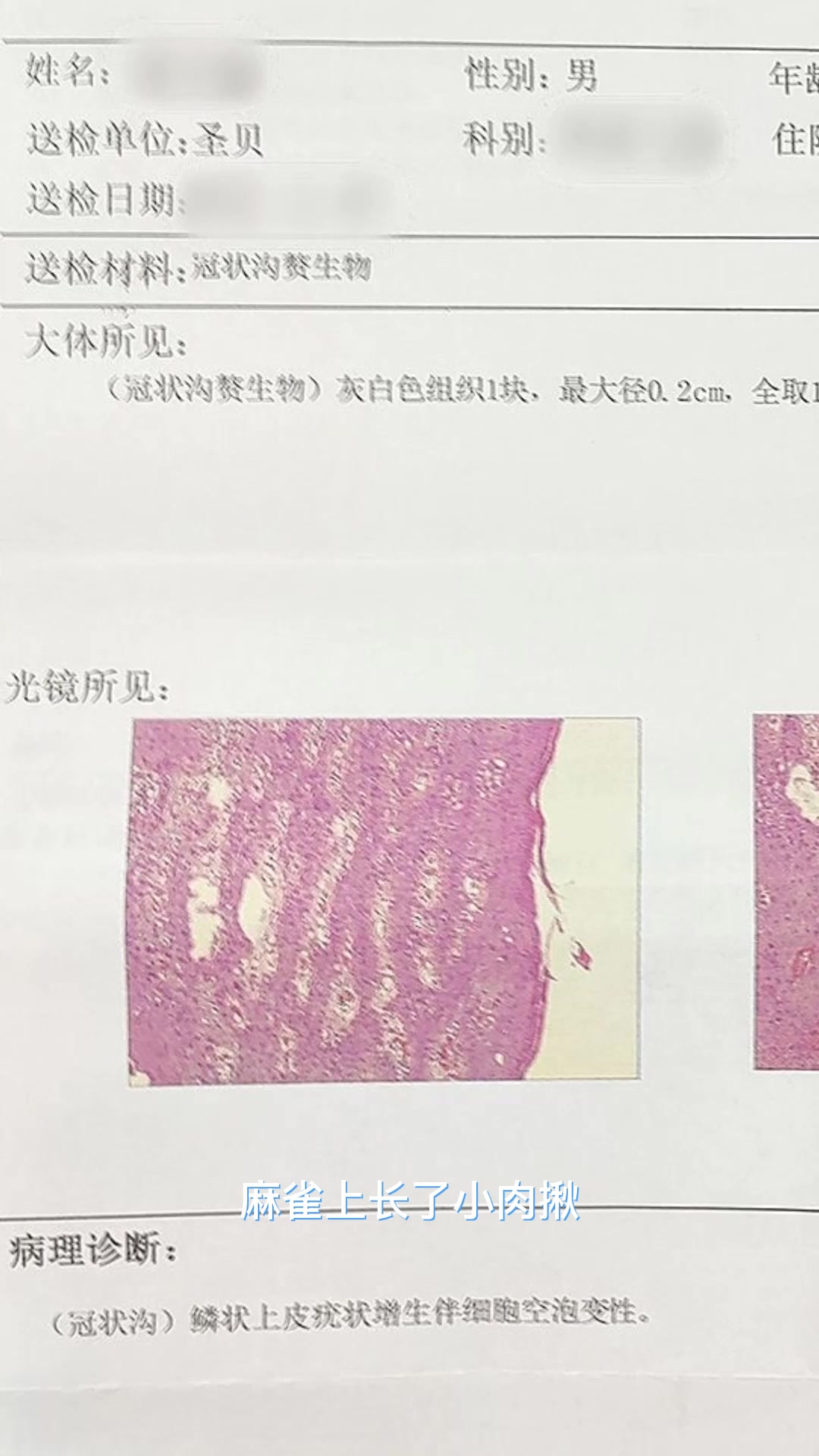 44岁男性隐私部位长了菜花赘生物