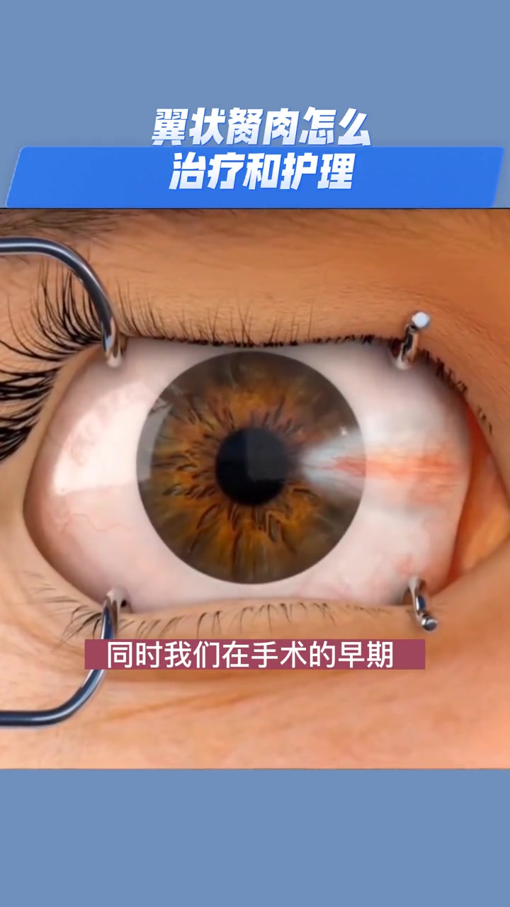 翼状胬肉怎么治疗和护理?翼状胬肉 眼科医生邓世靖