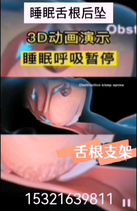 睡眠舌根后坠引起的打呼噜本人为什么听不到?