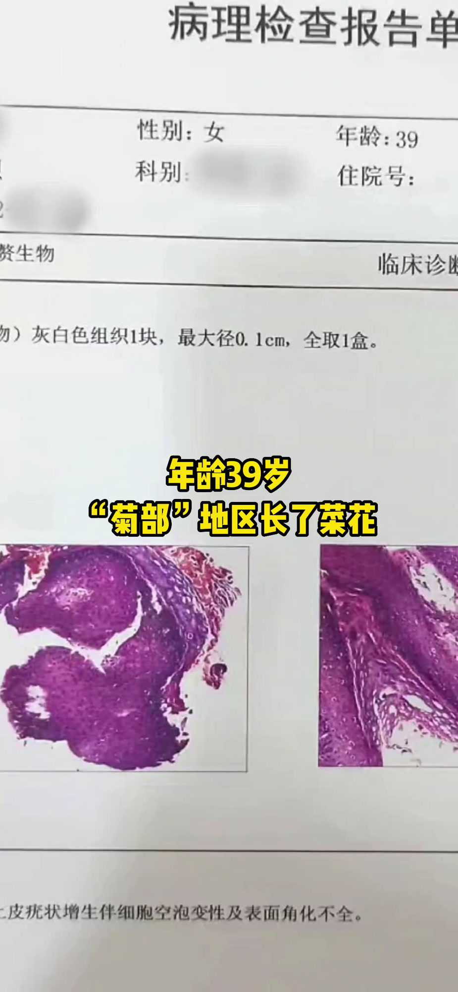 39岁女性肛周长菜花病毒疣