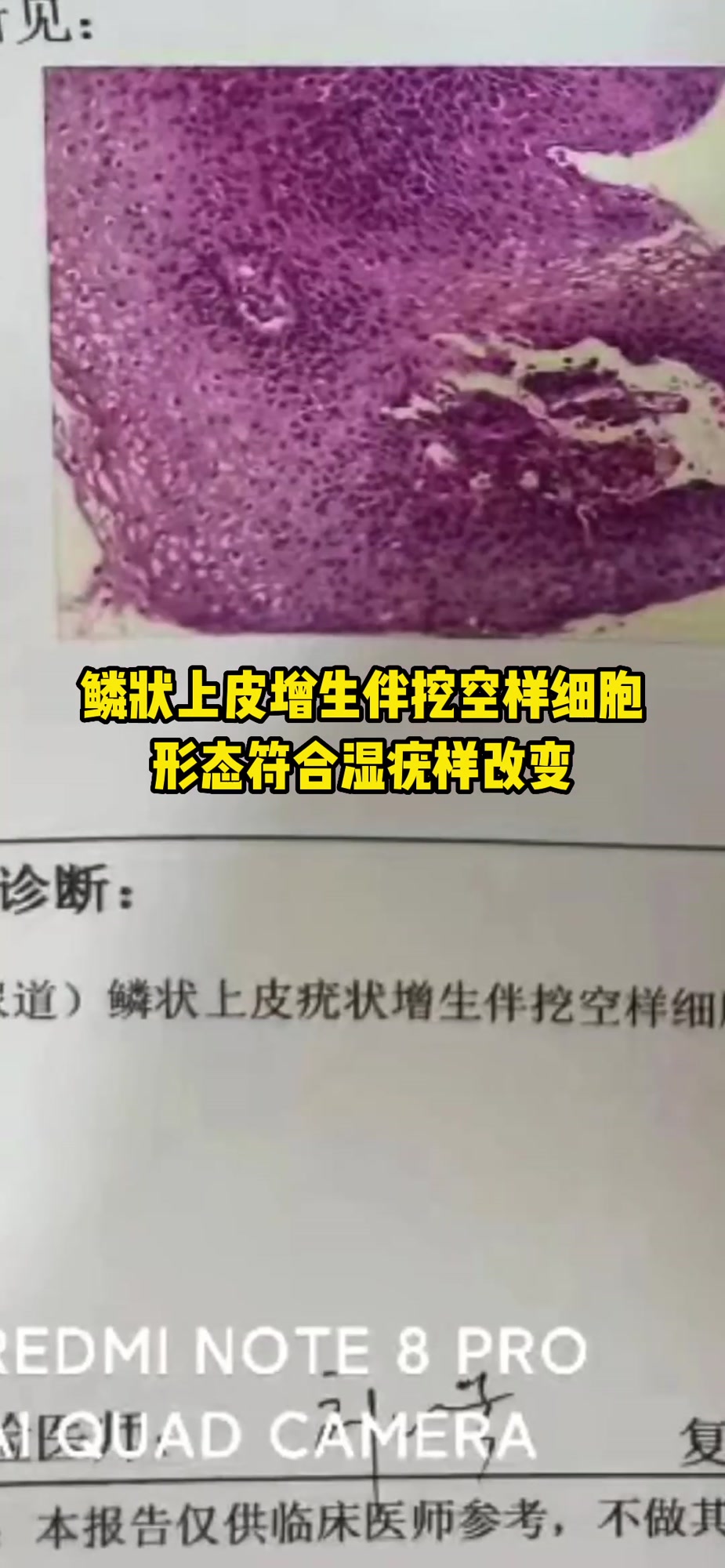 59岁女性那里长菜花病毒疣