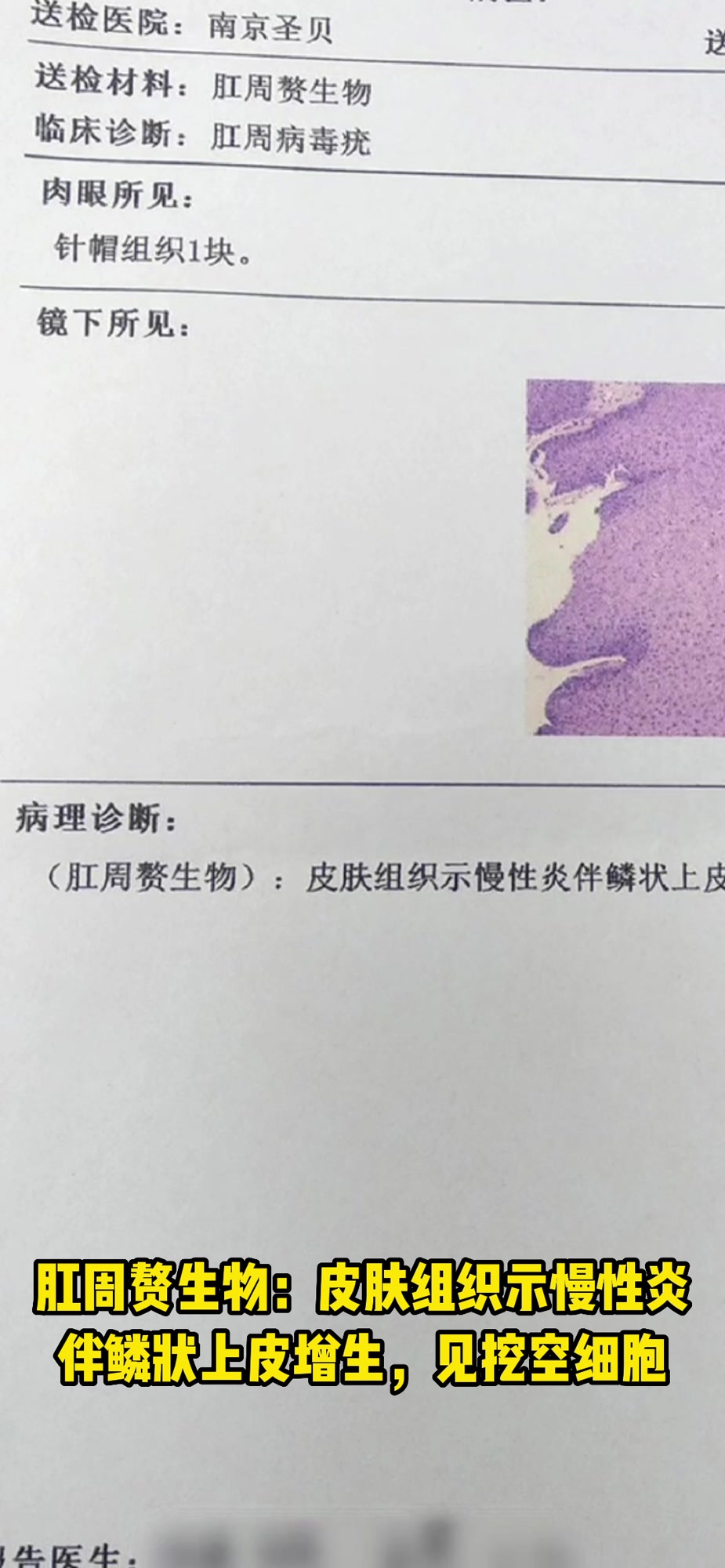 29岁男性肛周长菜花病毒疣