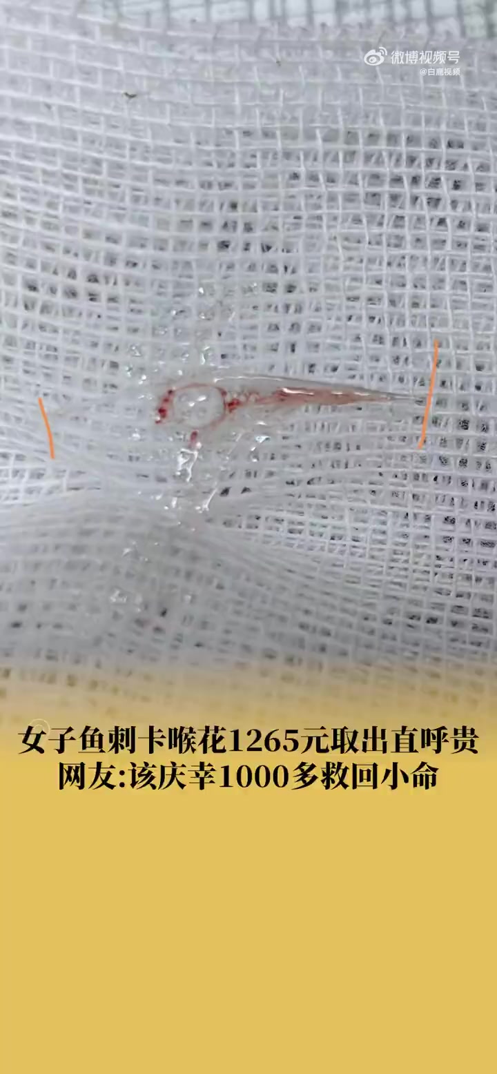 「女子鱼刺卡喉花1265元取出直呼贵 网友:该庆幸1000多救回小命」近日,北京。一女子遭