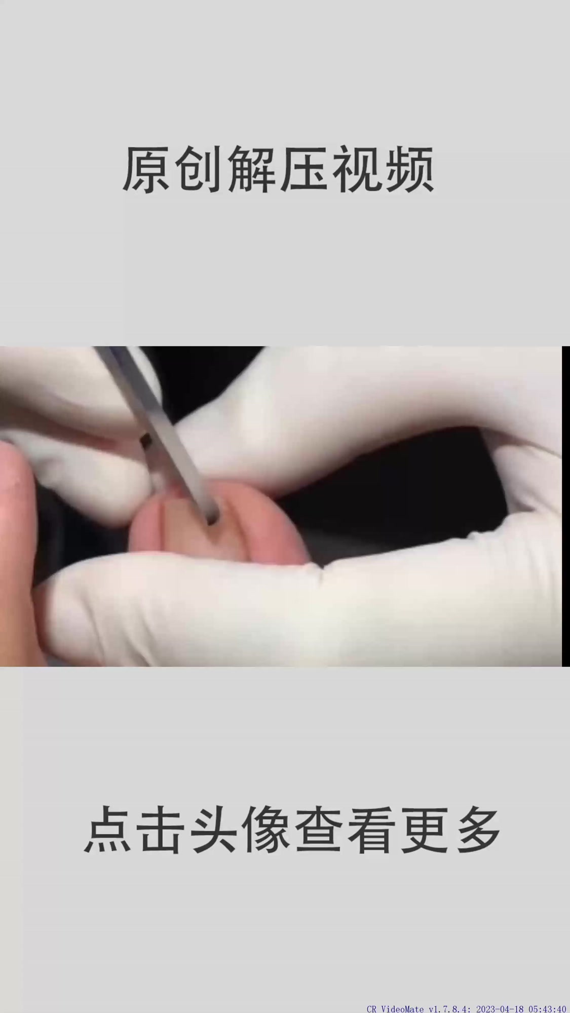 19. 指甲长到肉里了 修脚师的日常128