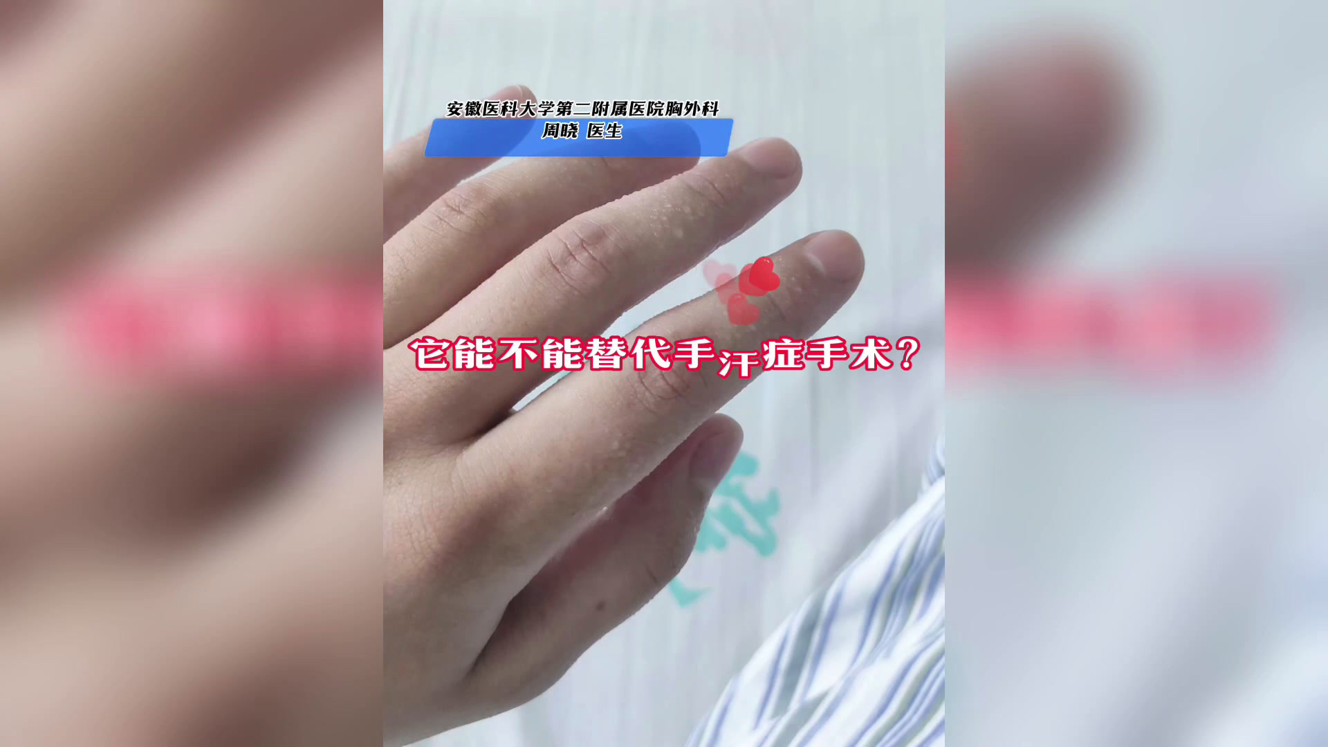 肉毒素能不能替代手汗症手术吗?