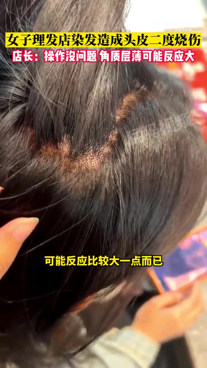 「女子染发头皮被烧伤店长称操作没问题:角质层薄可能反应大」4月21日,天津。女子理发店染发