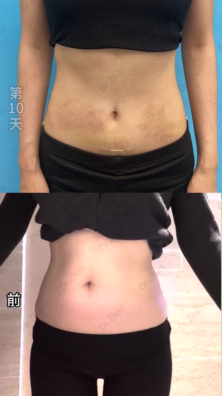 微胖女生吸掉肚子赘肉,第十天瘦成小蛮腰