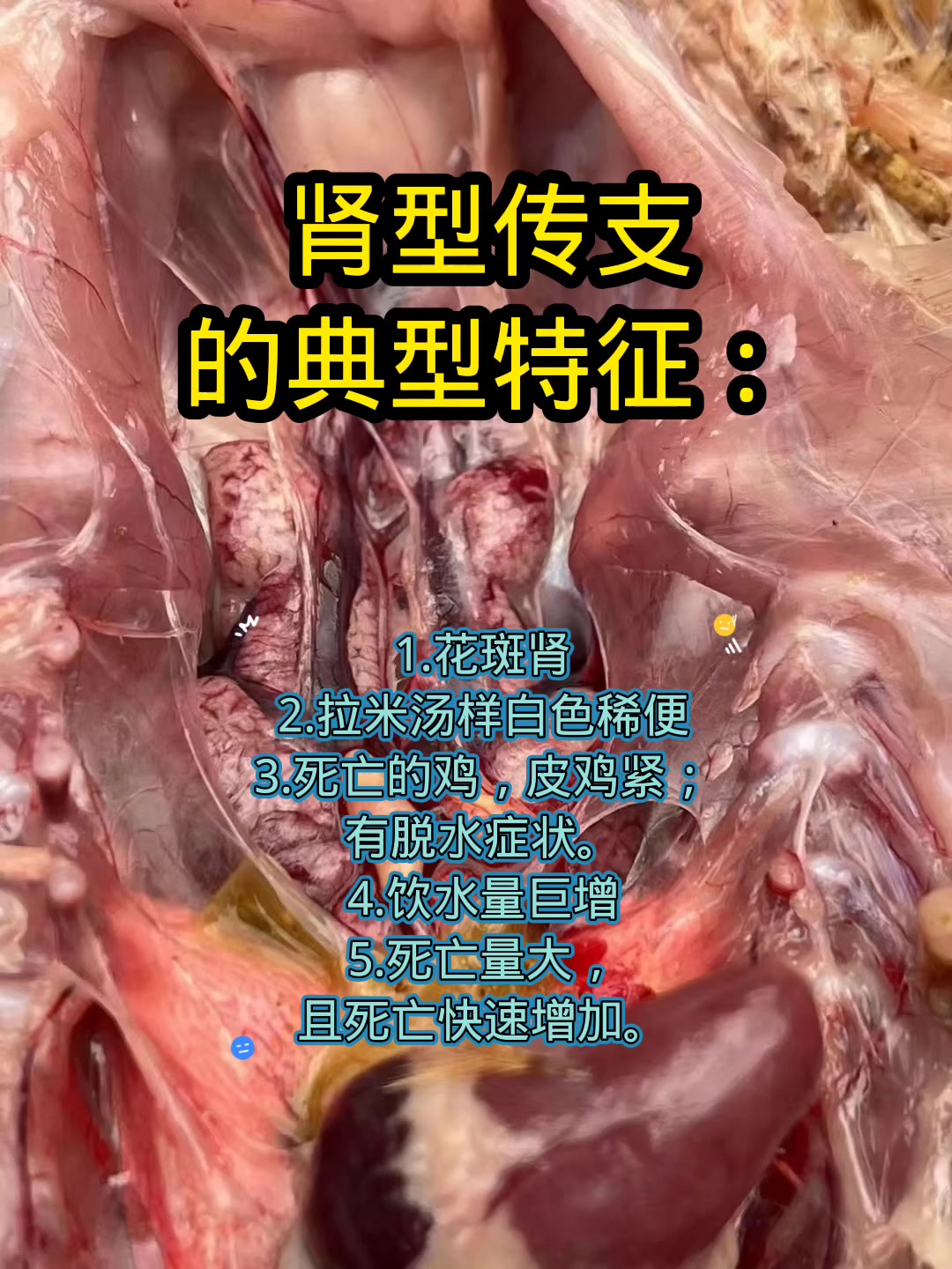肾型传支的典型特征