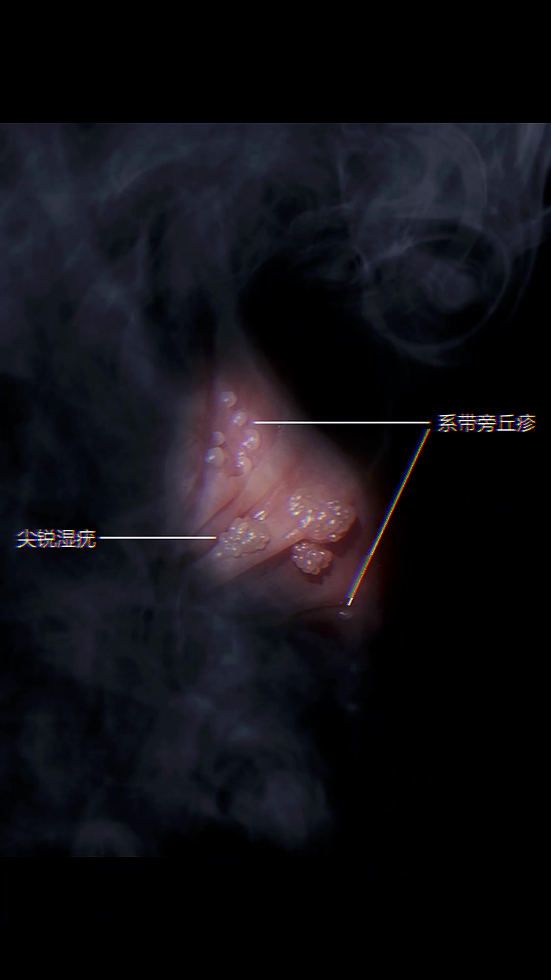 男生们注意了,别把这种丘疹混淆为长菜花