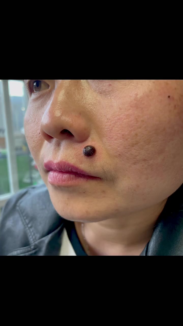 凸起来的大肉志