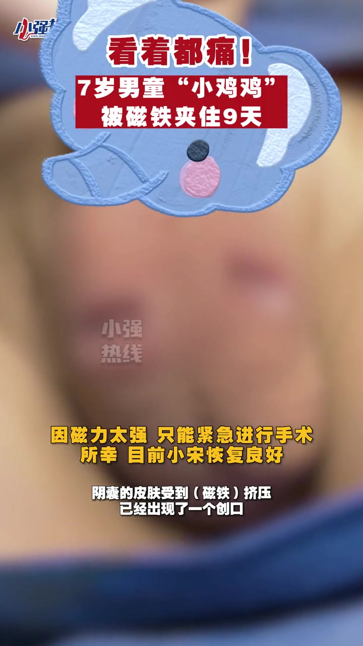 看着都痛!佛山 7岁男童“小鸡鸡”被磁珠夹了9天,发现时周围皮肤已感染化脓……社会百态