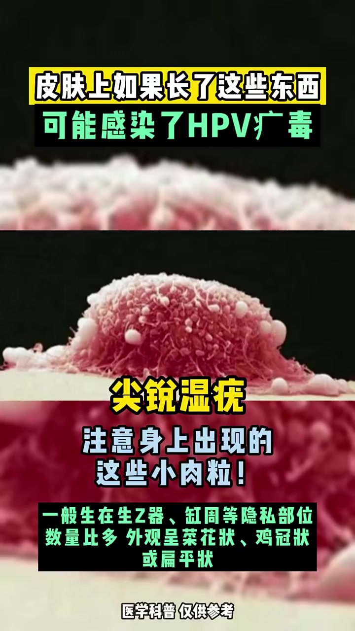 合肥hpv如果皮肤上张了这些东西可能是hpv