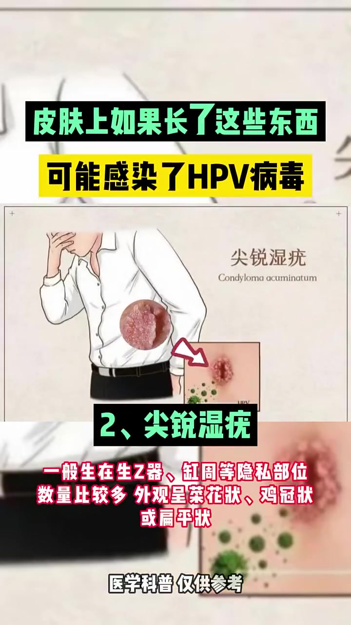合肥hpv专家提醒:皮肤上长了这些东西很可能感染了HPV!