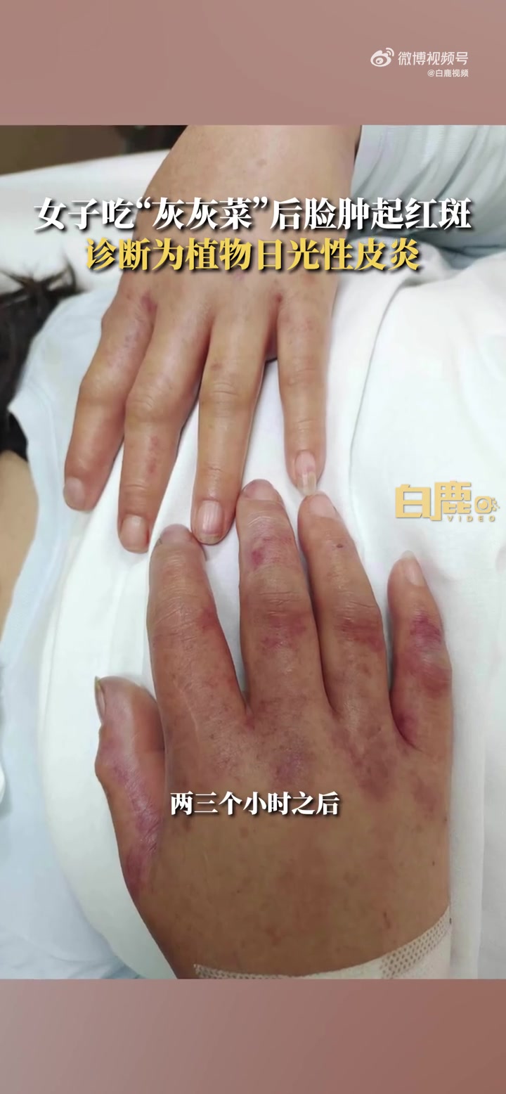 「警惕!女子吃野菜2小时后手脸水肿起红斑」近日,陕西西安。女子吃完“灰灰菜”下地干活,两三