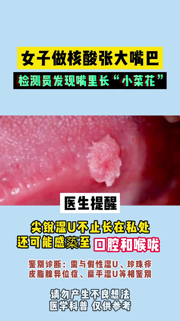 合肥治疗hpv医院:女子做核酸,嘴里长菜花,发现是尖锐湿疣!