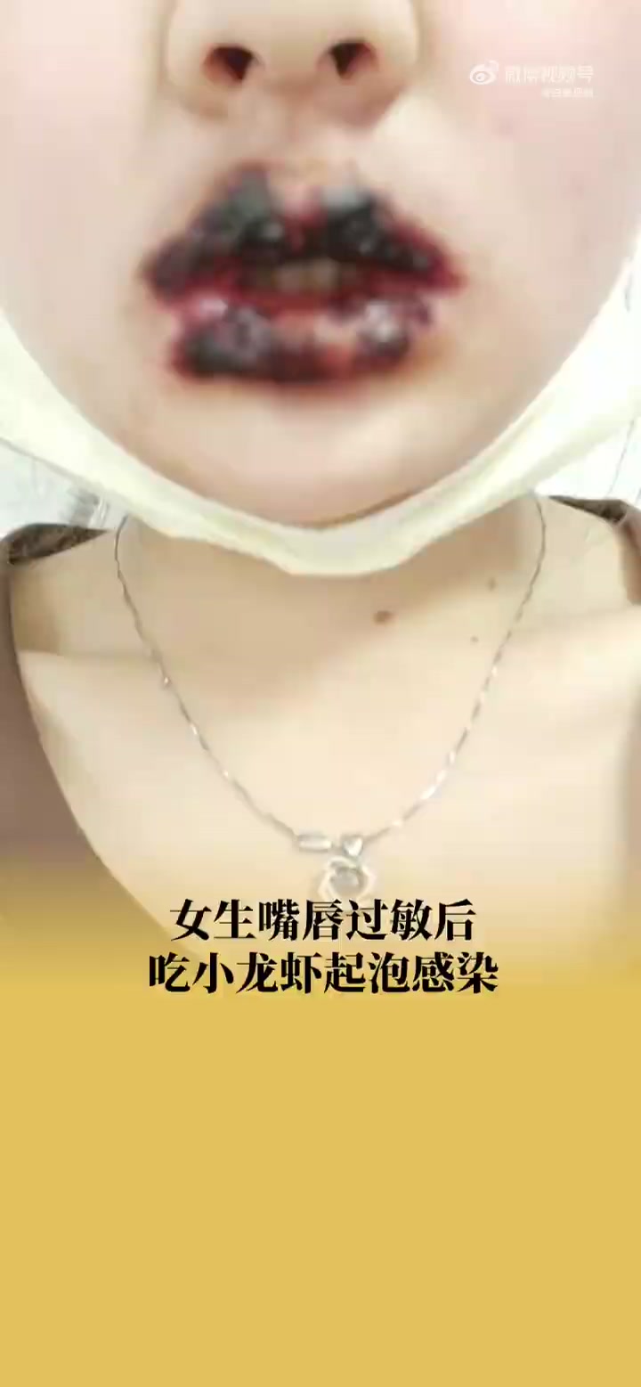 「女生过敏后吃小龙虾嘴唇溃烂住院:想靠吃虾来以毒攻毒」近日,四川成都。宋女士嘴唇过敏后还未